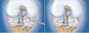 The Complete Guide To A Meniscus Tear Kinetic Labs