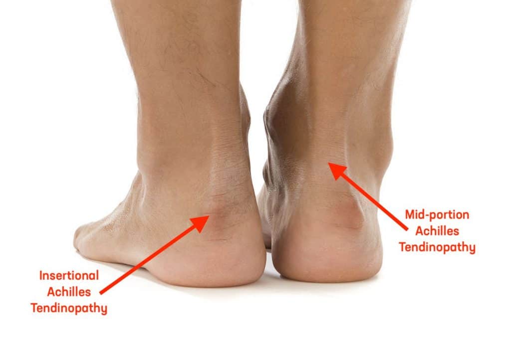 Quick Facts On Achilles Tendinitis Kinetic Labs