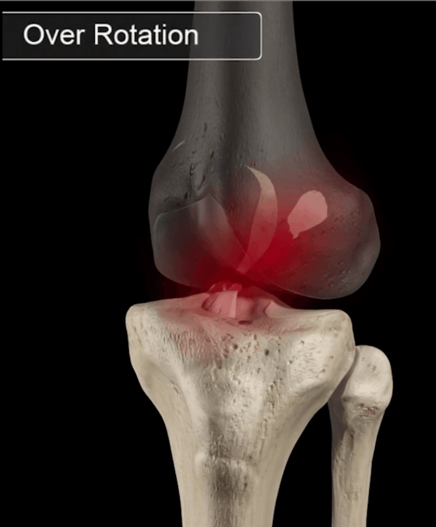 the-complete-guide-to-acl-tear-rehab-kinetic-labs