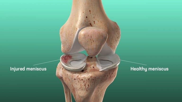 The Complete Guide To A Meniscus Tear Kinetic Labs