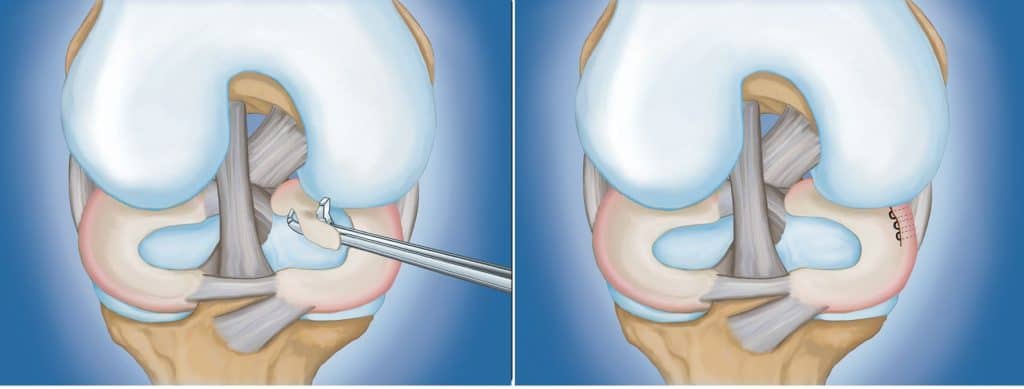 The Complete Guide to a Meniscus Tear Labs