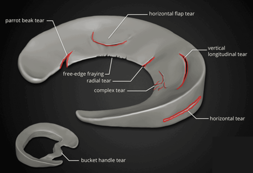 The Complete Guide to a Meniscus Tear Labs