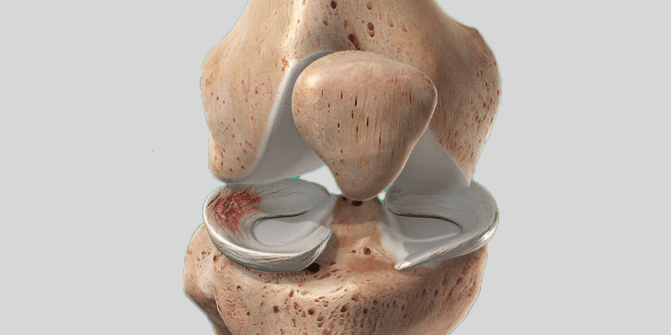 meniscus tear knee