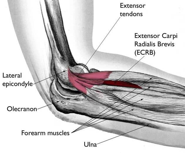 Quick Facts on Tennis Elbow - Kinetic Labs