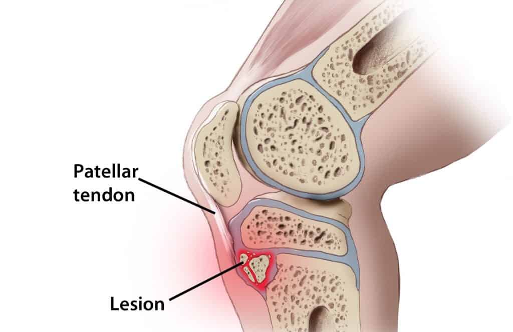 Osgood-Schlatter Disease knee pain location
