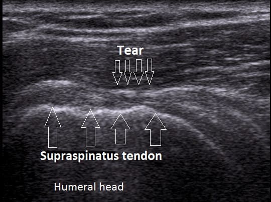 ultrasound imaging of a rotator cuff tear