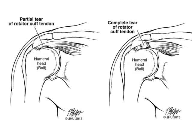 The Complete Guide To A Rotator Cuff Tear Kinetic Labs 3603