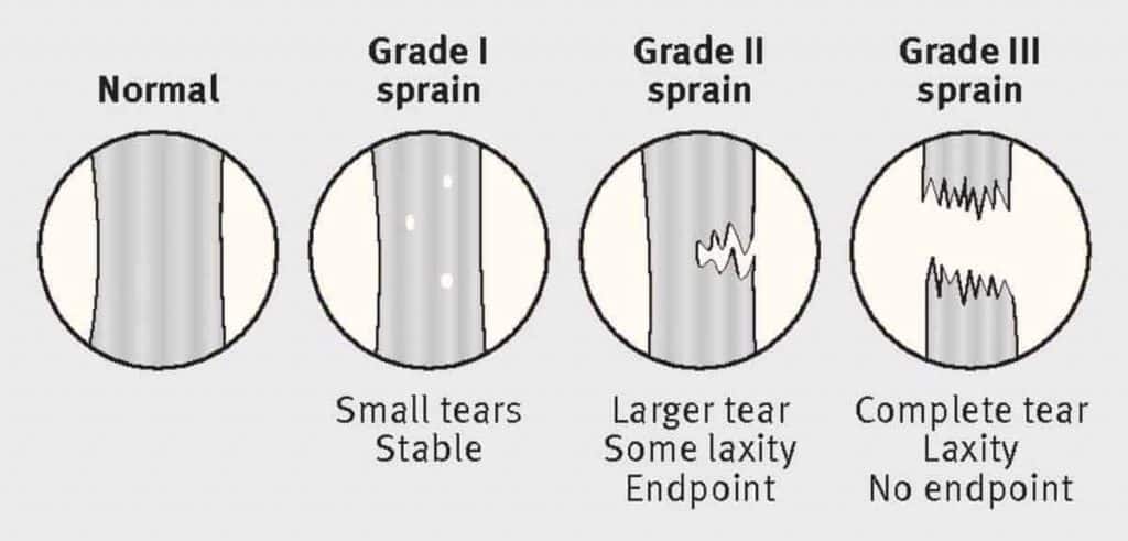 ligamrnt sprain grade classification for MCL tear