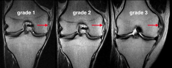 here-s-a-good-resource-for-knee-injury-prevention-torn-ligament-in-knee