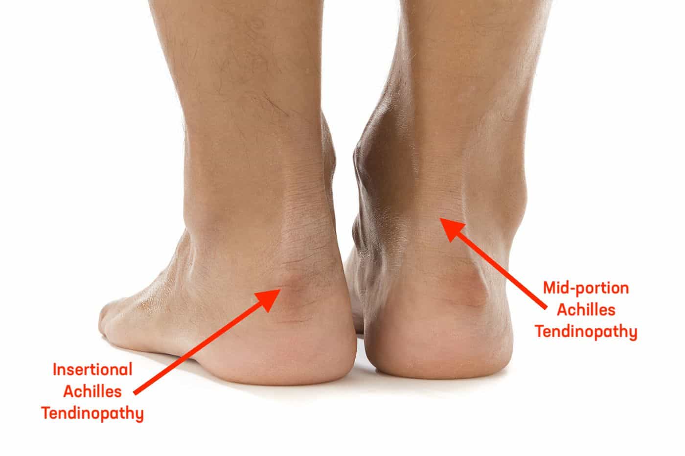 Tendonitis As Related To Achilles Tendinitis Pictures