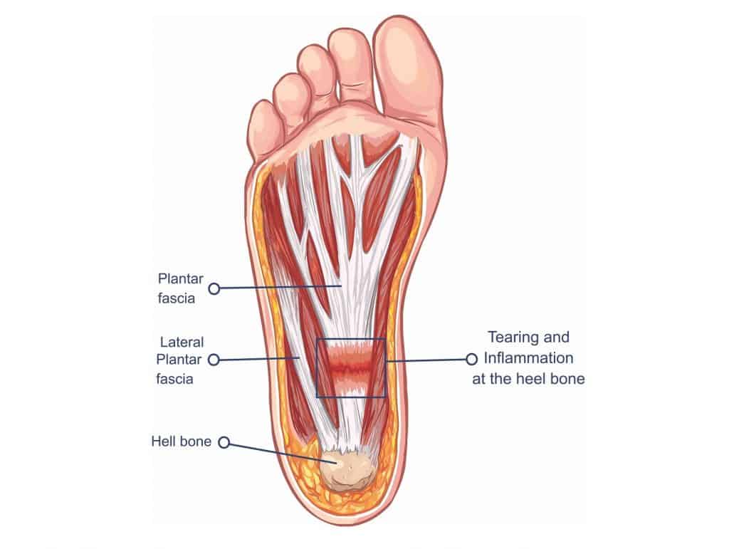 How To Say Plantar Fasciitis In German