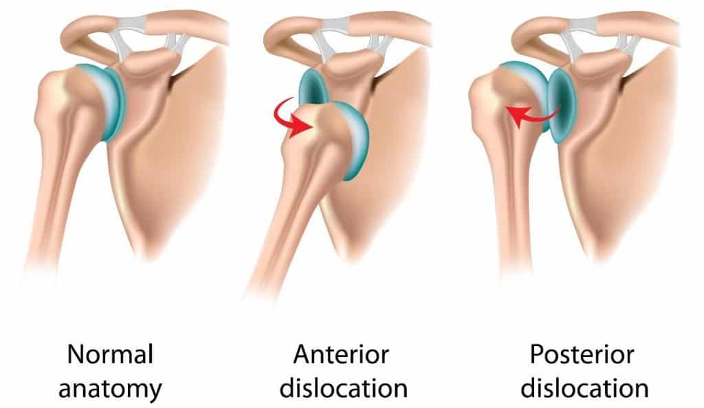 shoulder-dislocation