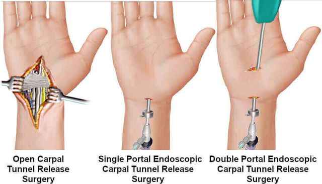 surgery for carpal tunnel syndrome