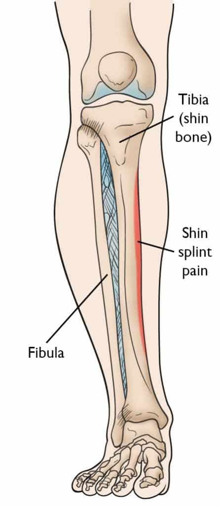 The Complete Guide To Shin Splints Kinetic Labs 5009