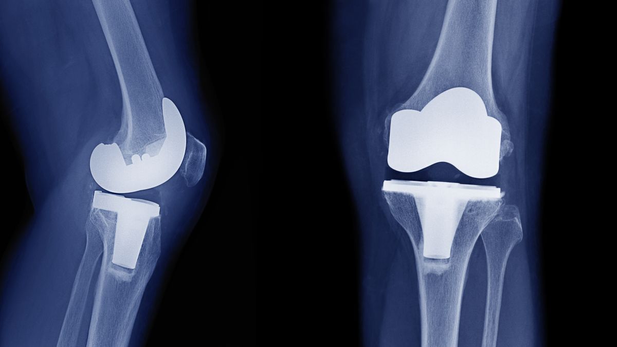 knee replacement toronto physiotherapy