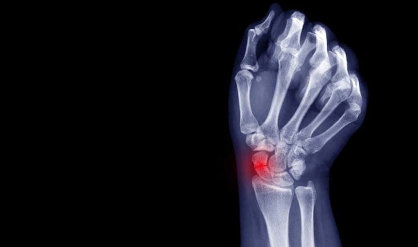 scaphoid fracture physiotherapy toronto