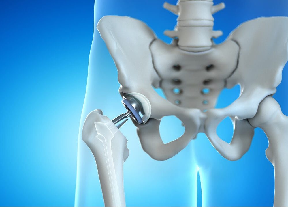 total-Hip-Replacement-physiotherapy-toronto