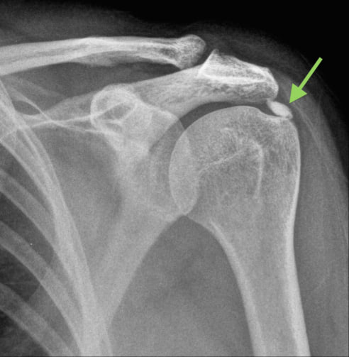 calcific tendinitis of the shoulder treatment toronto physio