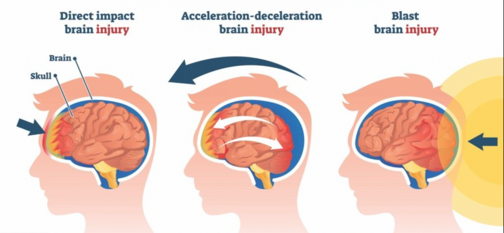 types of concussion injury mechanisms