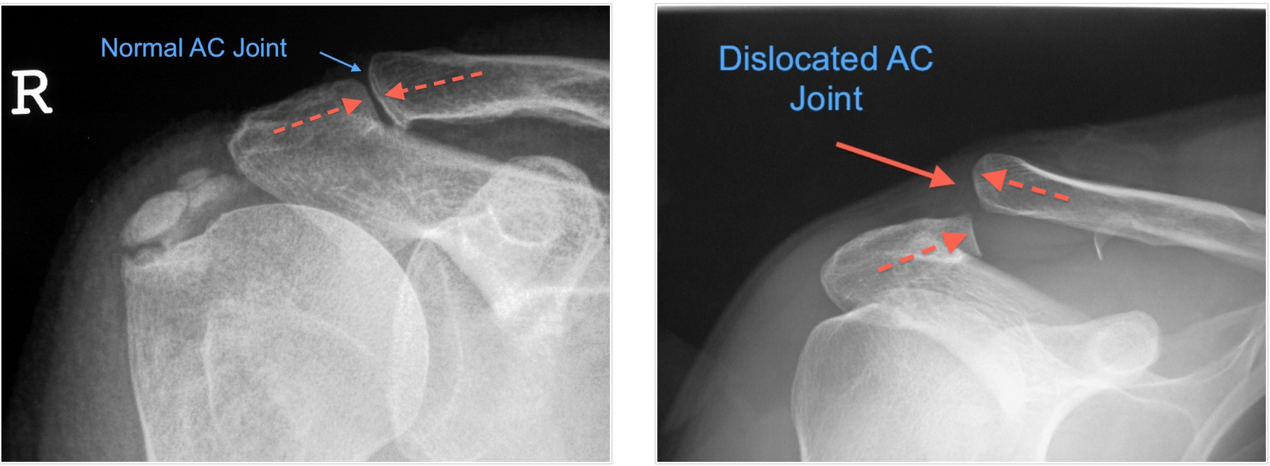 The Complete Guide To Ac Joint Separation Kinetic Labs