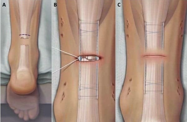 Achilles-tendon-rupture-surgery-repair