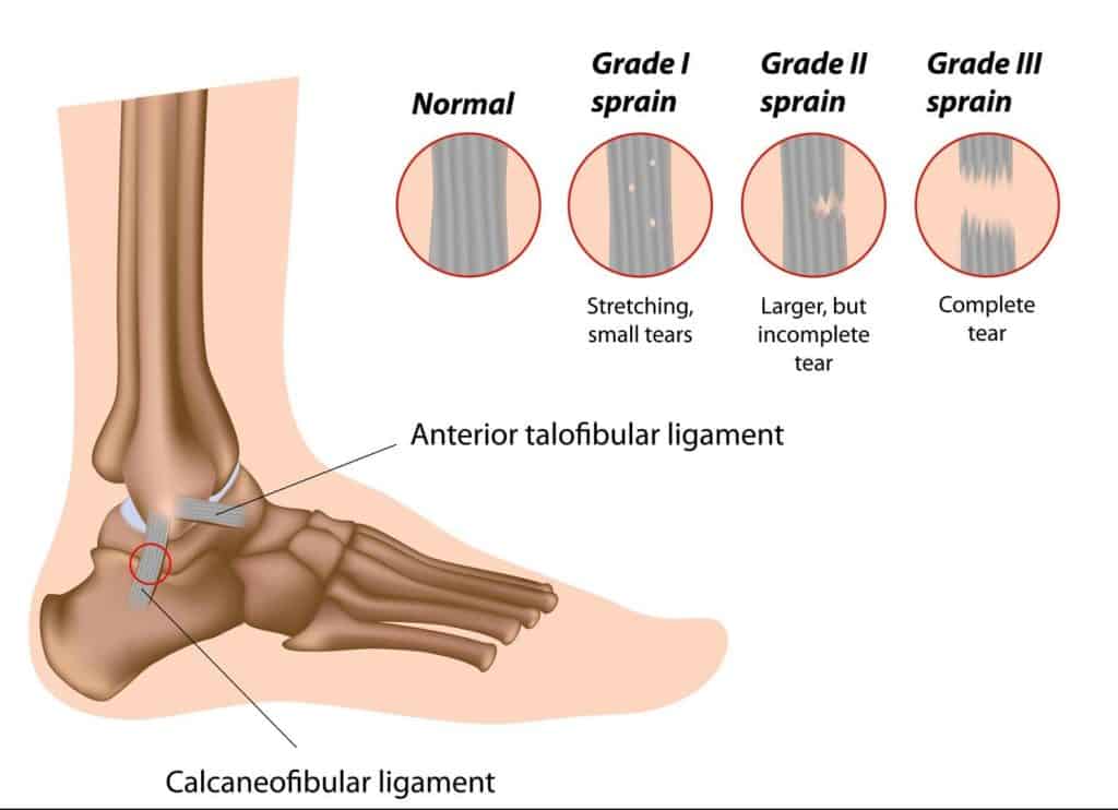 Chronic Ankle Instability, Recurrent Lateral Sprains (Strength, Plyometrics
