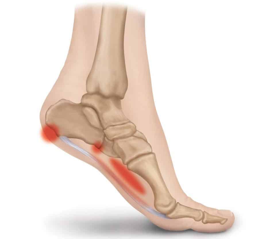 The Ultimate Guide to Plantar Fasciitis Treatment, symptoms and