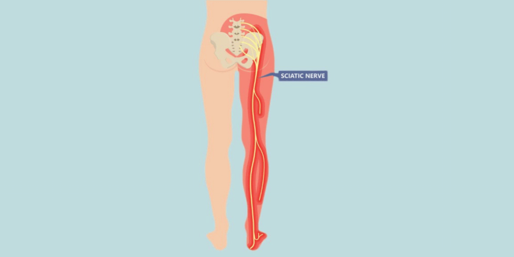 Massage Therapy For Sciatica Pain - Your Ultimate Guide to Pain
