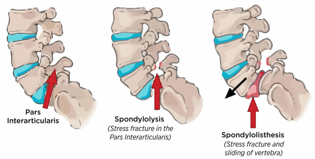 Spondylolysis-versus-spondylolisthesis-low-back-pain-toronto-1024x517