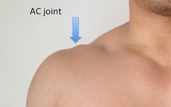 🥇 AC Shoulder Joint Separation Grading