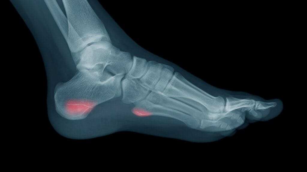 The Complete Guide to an Ankle Sprain - Kinetic Labs  Toronto  Physiotherapy, Chiropractic and Massage Therapy Clinic