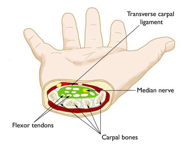 carpal_tunnel_syndrome_toronto