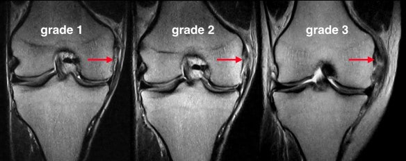 collateral-ligament-grading-injury-on-mri