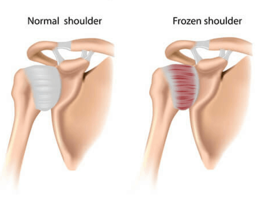 frozen shoulder versus normal shoulder