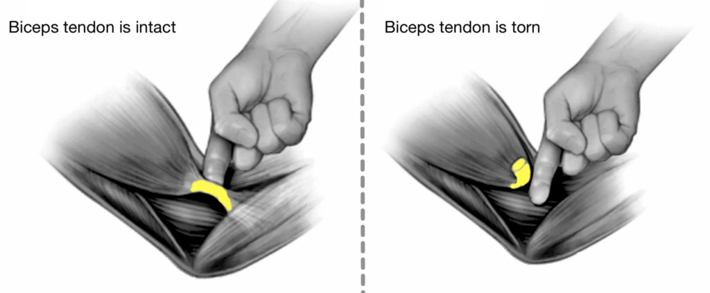 hook-test-for-biceps-tendon-rupture-1024x423