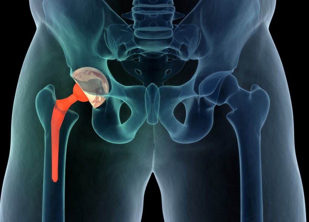 joint-replacement-hip