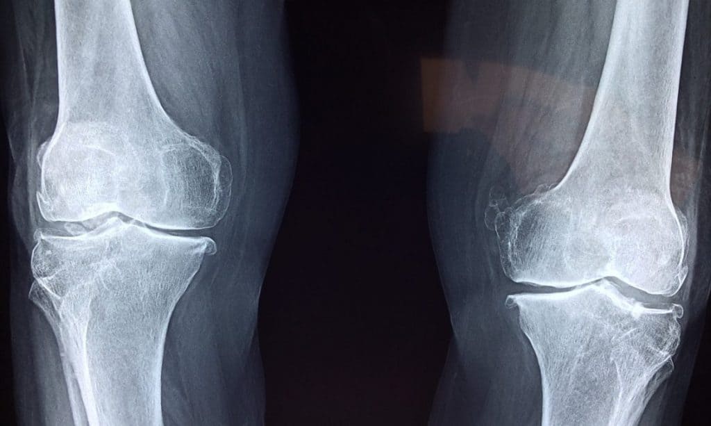 knee osteoarthiritis xray