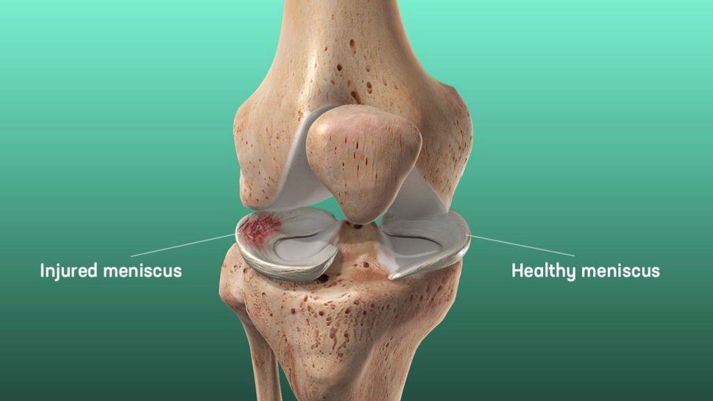 meniscus-anatomy-and-tear-min-1024x576