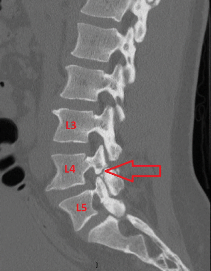 cpt code x ray cervical spine