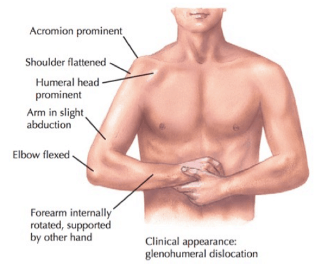 shoulder_dislocation_posture