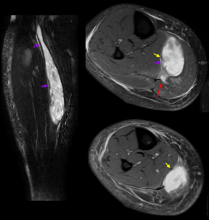 calf strain muscle imaging on MRI