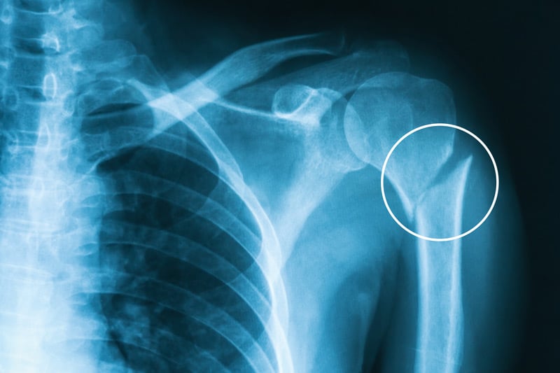 toronto-physiotherapy-humerus-fracture