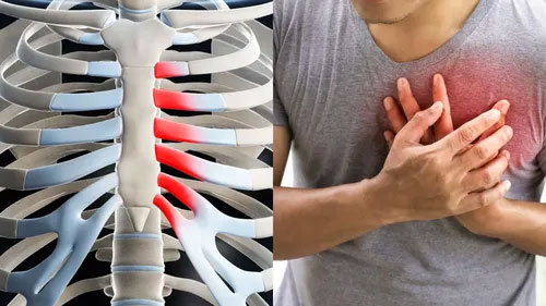 costochondritis-rib-pain-toronto-treatment